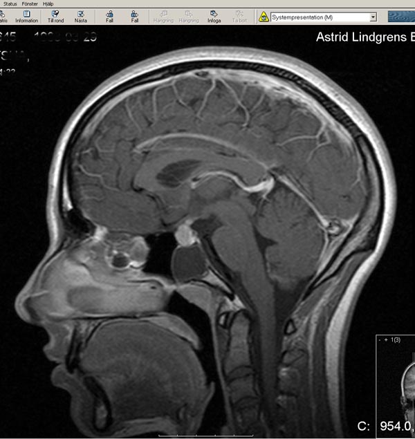 mri brain scan. Photo Rework. MRI scan